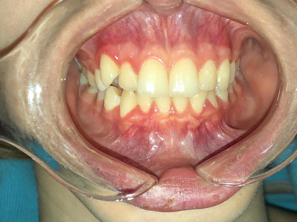 beyaz ışık ortodonti tedavileri