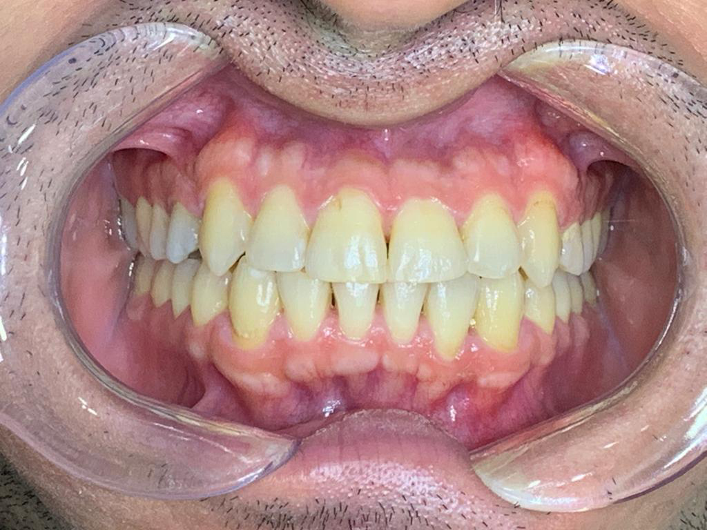 beyaz ışık ortodonti