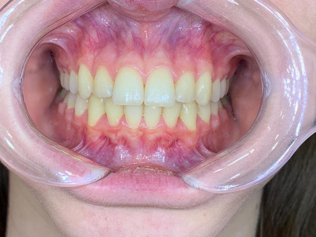 beyaz ışık tedavisi ortodonti