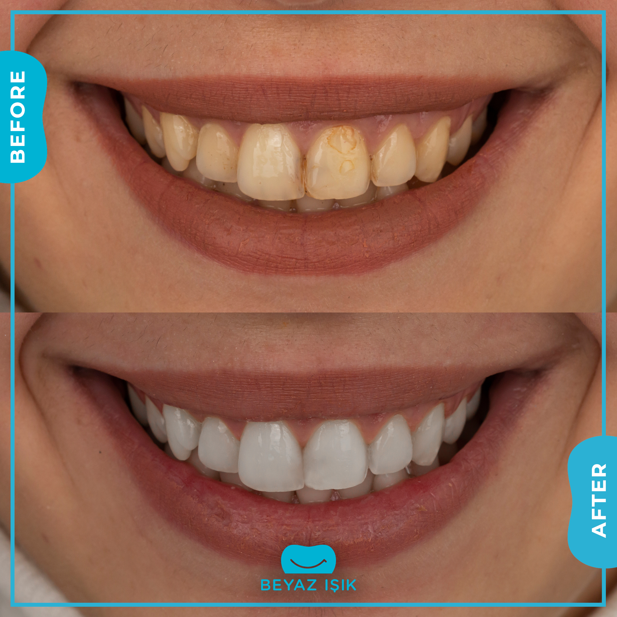 Teeth After and Before Whitening